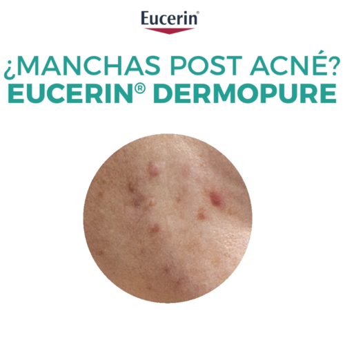 ¿Manchas tras el verano? Eucerin® tiene la solución